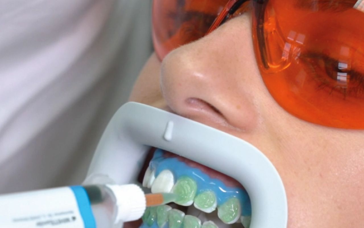 bleach-step2 Zahnbleaching Schutz