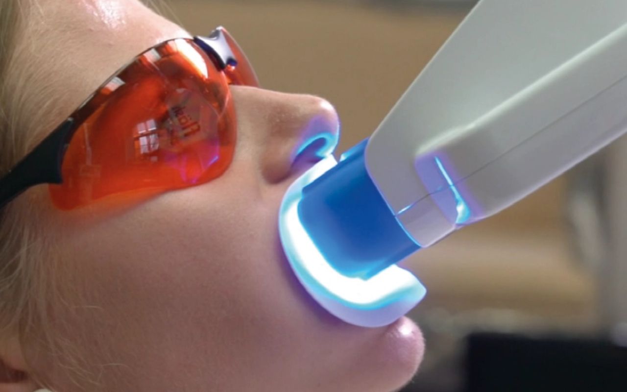 bleach-step3 Zahnbleaching Lampe